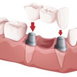 Dental bridge