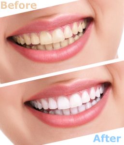 tooth whitening