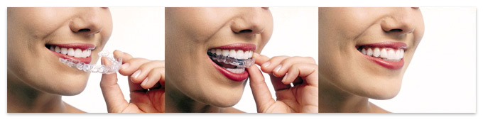 Invisalign Braces in New York City