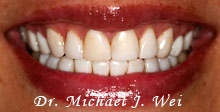 angela v before porcelain veneers