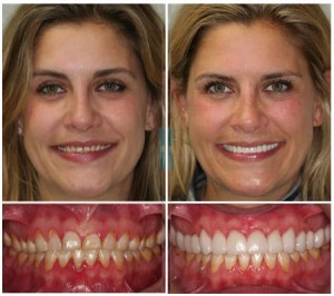 Porcelain Tooth Crowns Before & After Photos by Dr. Michael J Wei, DDS - Manhattan NYC Dentistr