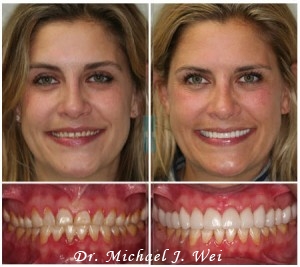 Porcelain Tooth Crowns Before & After Photos by Dr. Michael J Wei, DDS - Manhattan NYC Dentistr