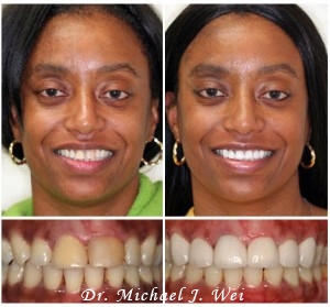 Tooth Lumineers Before & After Photos - By Dr. Michael J. Wei, DDS - Cosmetic Dentist in Manattan NYC