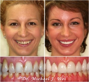 Porcelain Veneers - By Dr. Michael J. Wei, Cosmetic Dentist in Manhattan NYC