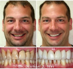 Smile Makeover Cosmetic Dentist by Dr. Michael J. Wei, DDS - Manhattan NYC