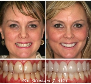Porcelain Veneers Before and After Photos - By Michael J Wei, DDS - Cosmetic Dentist in Manhattan NYC New York City
