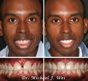 Before and After Photos of Porcelain Veneers - By Michael J Wei, DDS - Cosmetic Dentist in Manhattan NYC New York City