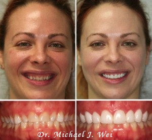 Smile Makeover - Before and After Photos of Porcelain Veneers by Dr. Michael J. Wei, DDS - Cosmetic Dentist in Manhattan NYC