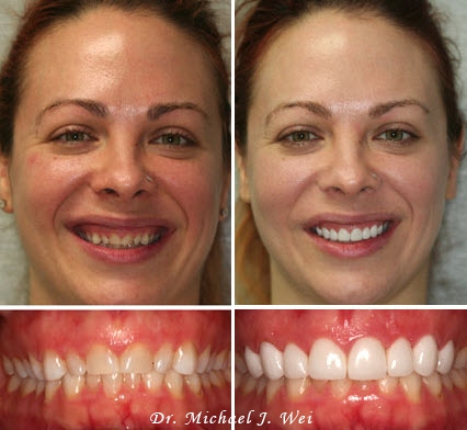 Erica Gets a Beautiful Smile with Porcelain Veneers