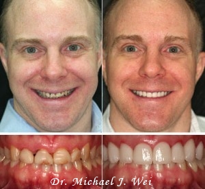 Before and After Photos - Porcelain Veneers & Crowns by Manhattan NYC Cosmetic Dentist Dr. Wei