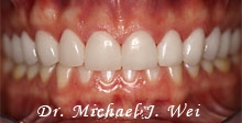 lindsay l smile after retracted