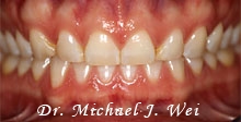 lindsay l smile before retracted