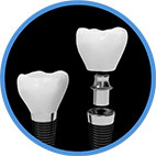 dental implants