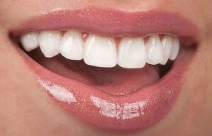 Composite Veneers