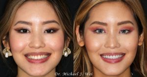 Jarry L Before/After Veneers