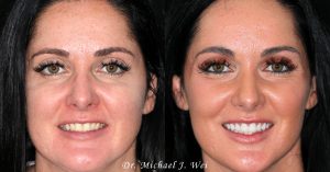 Deborah C Before and After Smile Makeover