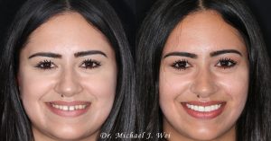 Gabriela Face Before and After Smile Makeover