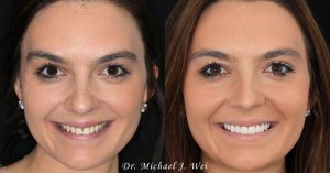 Gabrielle R Before and After Smile Makeover