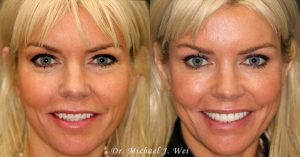 Kerry W Face Before and After Smile Makeover