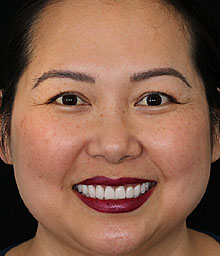 Quynh T After Smile Makeover 220x256