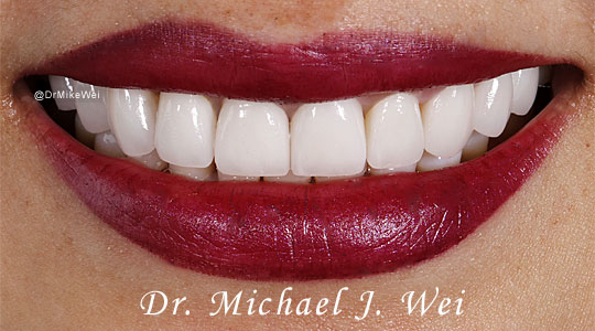 Quynh T After Smile Makeover 540x300