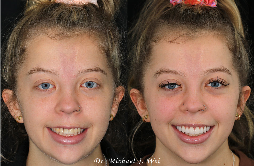 Laura T smile makeover Dr Michael J Wei