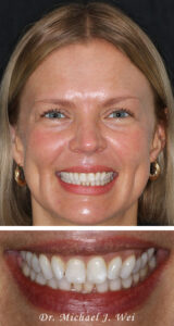 Helena R Composite Before