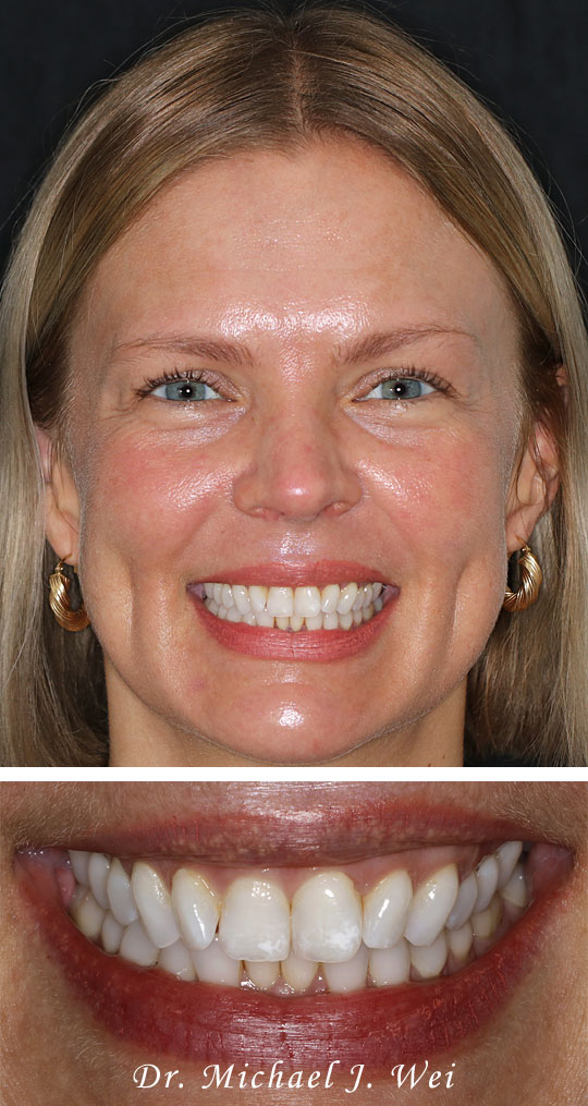 Transform Your Smile Makeover with Gum Contouring