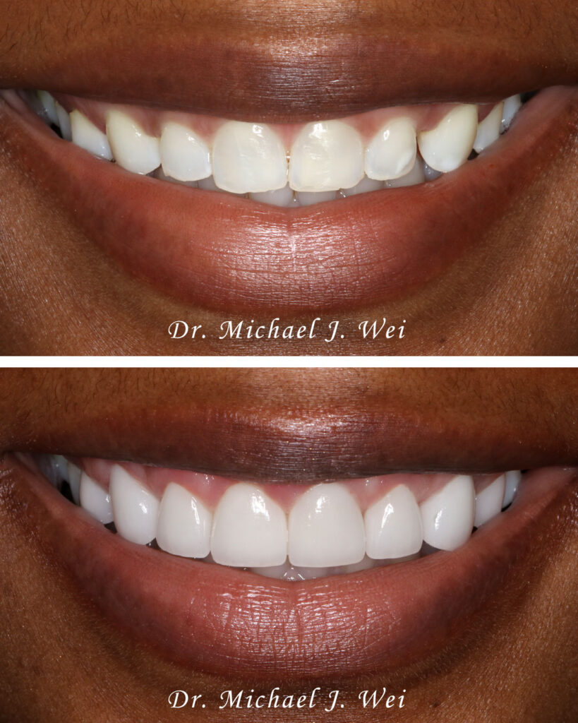Prepless Veneers Manhattan New York City cosmetic dentist Dr. Michael Wei