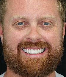 Andrew B Face After Smile Makeover 222x256