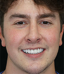 Mathew M Face After Smile Makeover 220x256