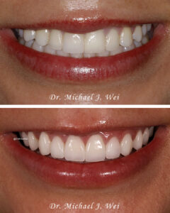 America veneers NYC smile makeover Dr. Michael J Wei 2