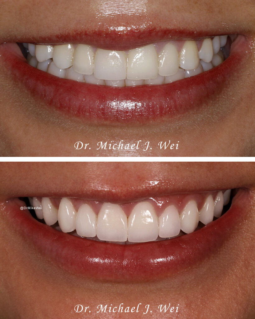 NYC Smile Makeover of the Month The Magic of 10 Porcelain Veneers