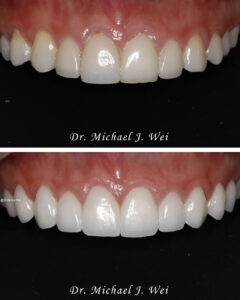 America veneers NYC smile makeover Dr. Michael J Wei