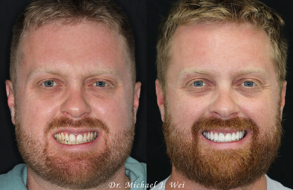 Smile Makeover of the Month MinimalPrep Veneers and Crowns Michael