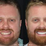 Andrew before and after veneers and crowns 1