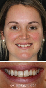 Morgan M smile makeover Dr. Michael J. Wei