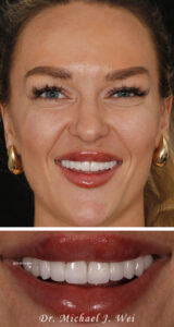 Antonia A Composite After Smile Makeover 540x1015