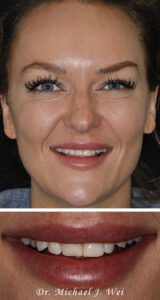 Antonia A Composite Before Smile Makeover 540x1015