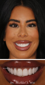 Justina D Composite After Smile Makeover 540x1015