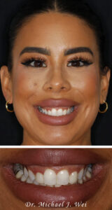 Justina D Composite Before Smile Makeover 540x1015