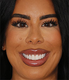 Justina D Face After Smile Makeover 220x256
