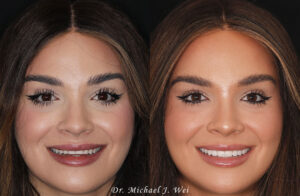 brooke smile makeover dr michael j wei nyc before and after