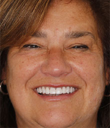 Marianne P Face After Smile Makeover 220x256