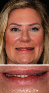 Patricia C Composite Before Smile Makeover 540x1015