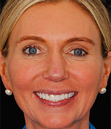 Maura K Face After Smile Makeover 220x256