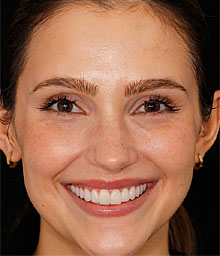 Hannah D Face After Smile Makeover 220x256