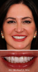 Kelly W Composite After Smile Makeover 540x1015