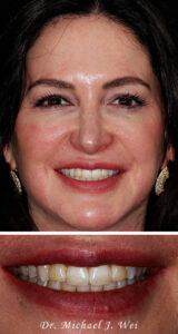 Kelly W Composite Before Smile Makeover 540x1015