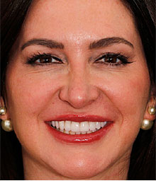 kelly smile makeover minimal prep veneers